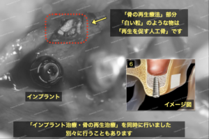 骨造成として、人工骨を施します。これを元に再生して行きます。